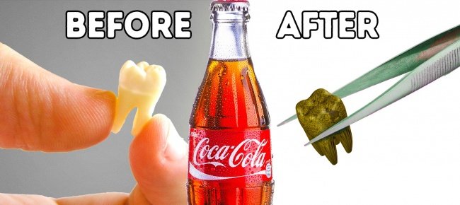 Coca cola sẽ làm cho bạn bị mòn men răng, sâu răng và răng ố vàng