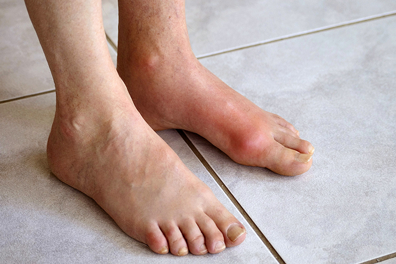 Bệnh Gout gây đau nhức và ảnh hưởng đến chức năng vận động của xương khớp.